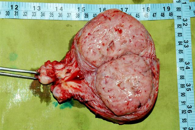 430 grams fibroid uterus,Cut section